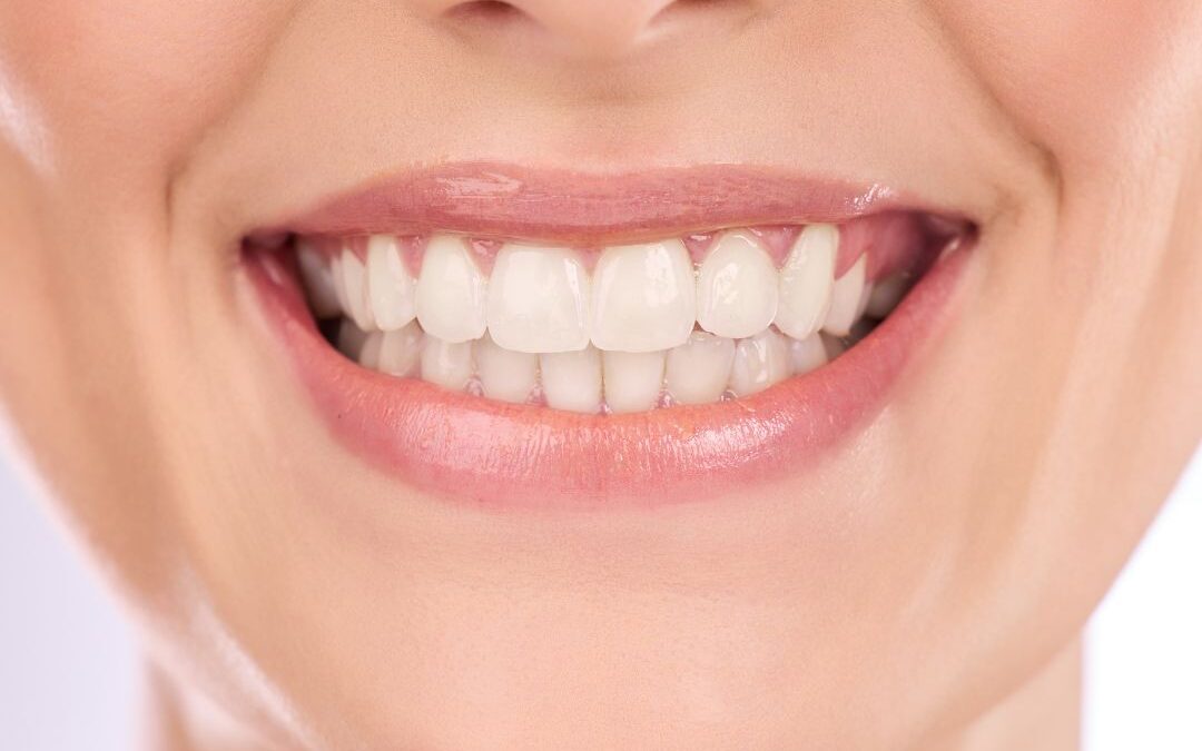 Quali sono gli aspetti Fondamentali da sapere sullo sbiancamento denti professionale ?